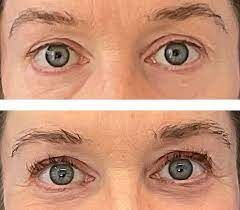 Latisse Before and After: The Dramatic Difference Latisse Makes to Your Look